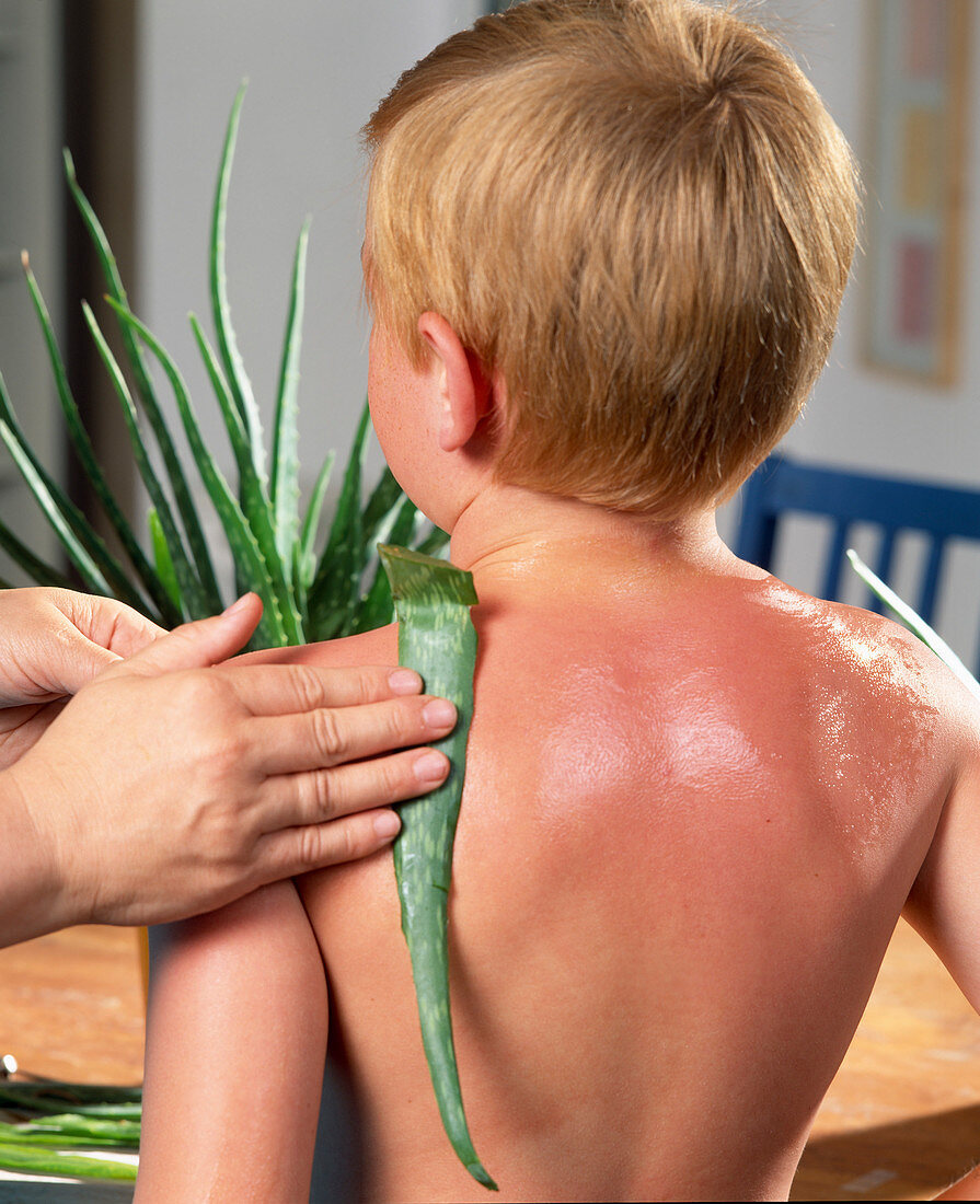 Relief of sunburn with gel from the leaves of aloe vera